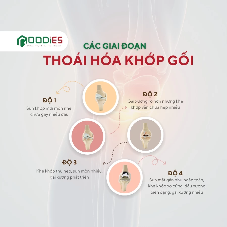 BẠN ĐÃ BIẾT CÁC GIAI ĐOẠN CỦA THOÁI HÓA KHỚP GỐI?