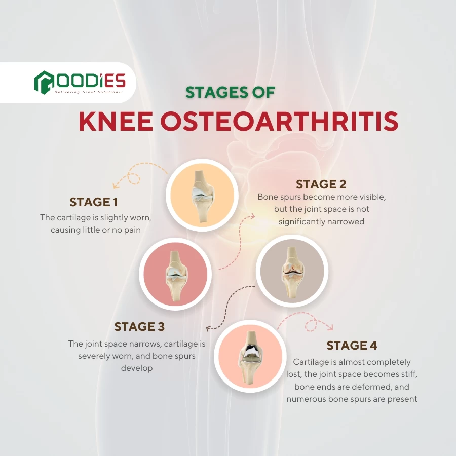 DO YOU KNOW THE STAGES OF KNEE OSTEOARTHRITIS?