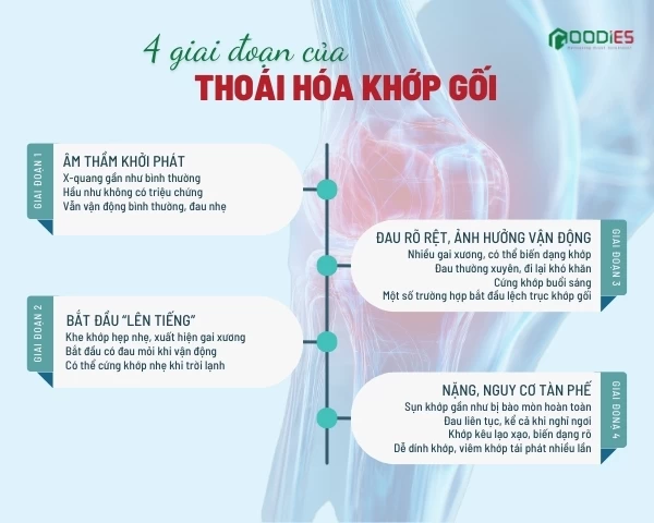 THOÁI HÓA KHỚP GỐI – BẠN ĐANG Ở GIAI ĐOẠN NÀO?