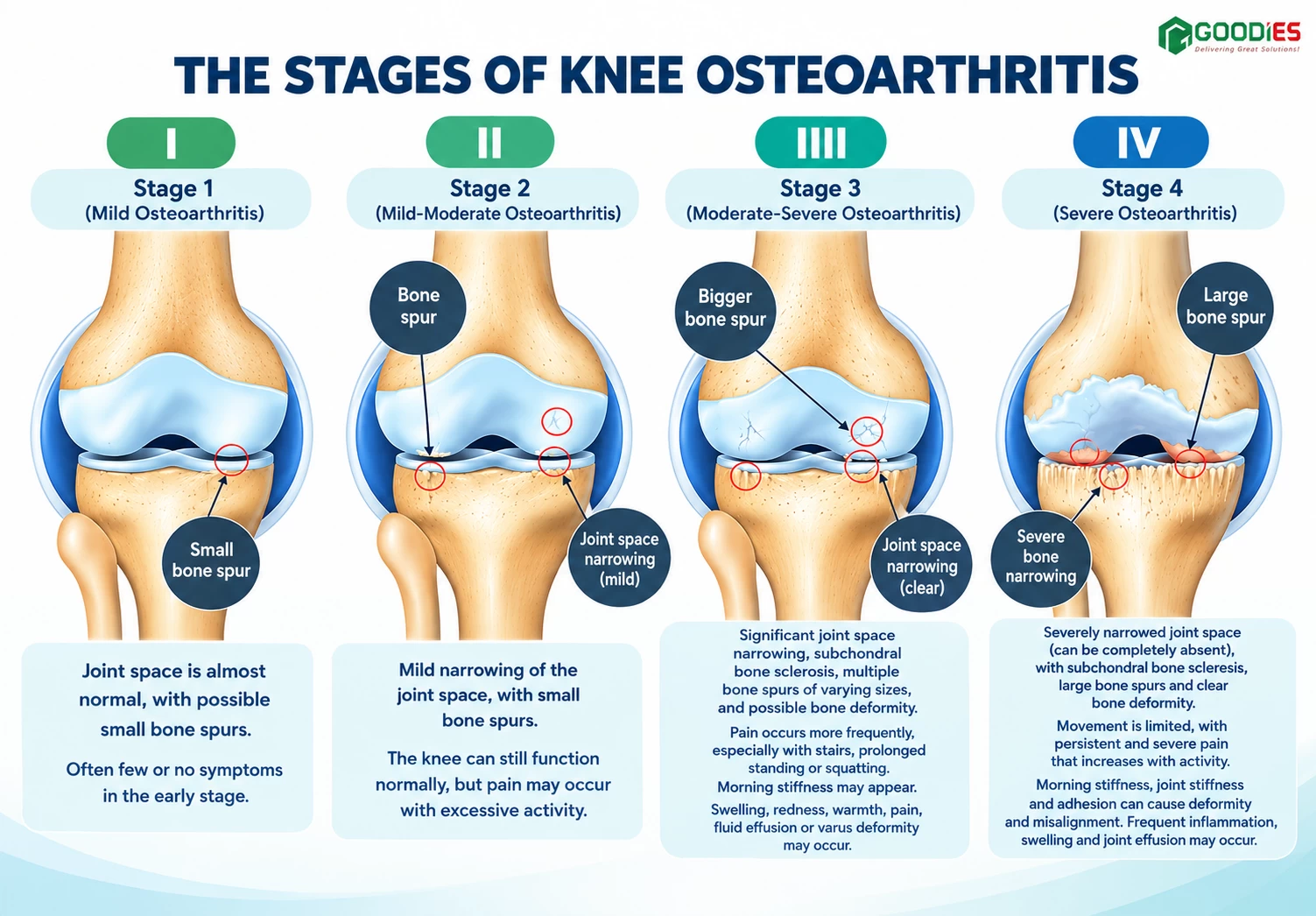 HOW DOES KNEE OSTEOARTHRITIS PROGRESS THROUGH 4 STAGES?
