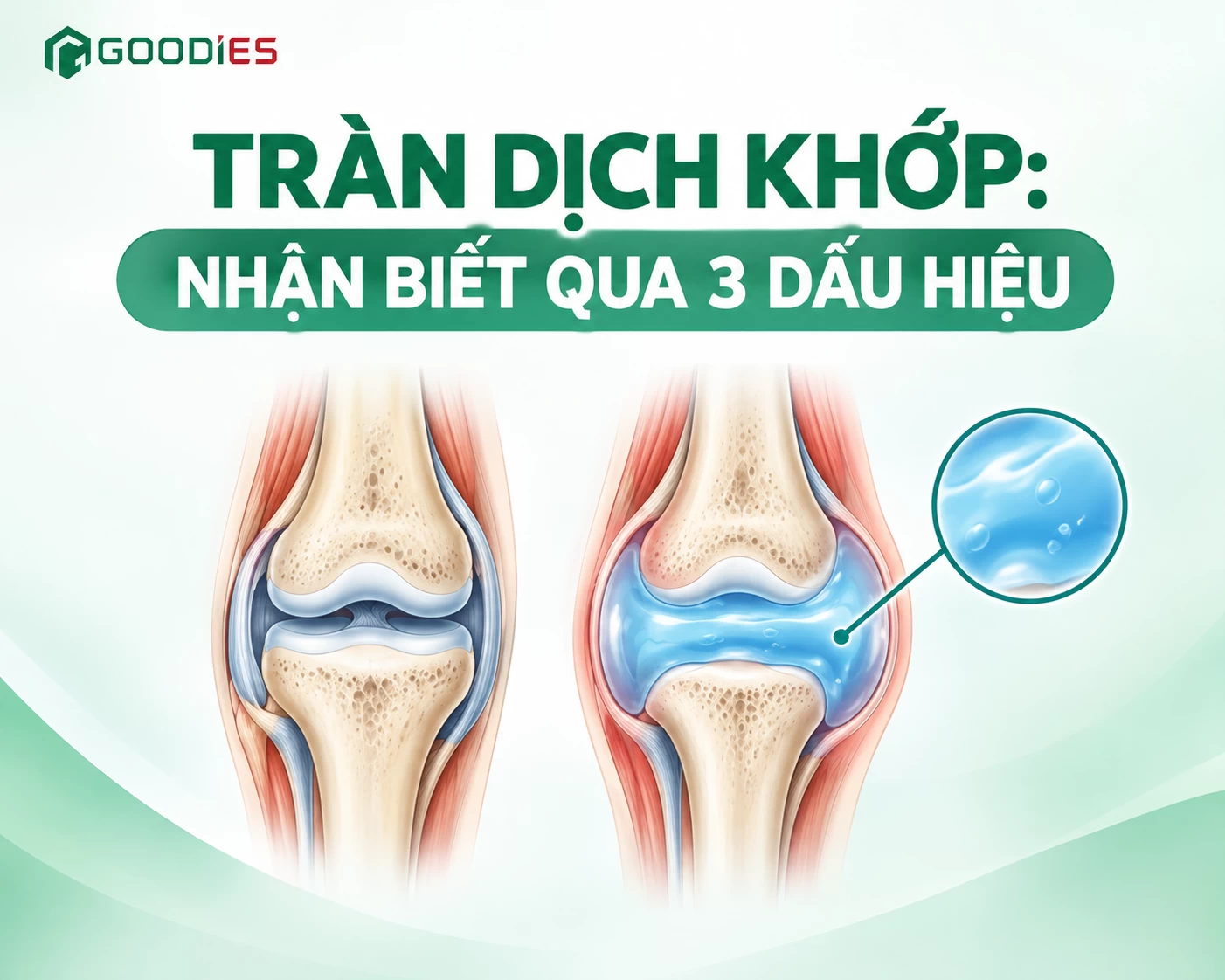KHỚP SƯNG TO, ĐAU NHỨC – CẨN THẬN TRÀN DỊCH KHỚP!